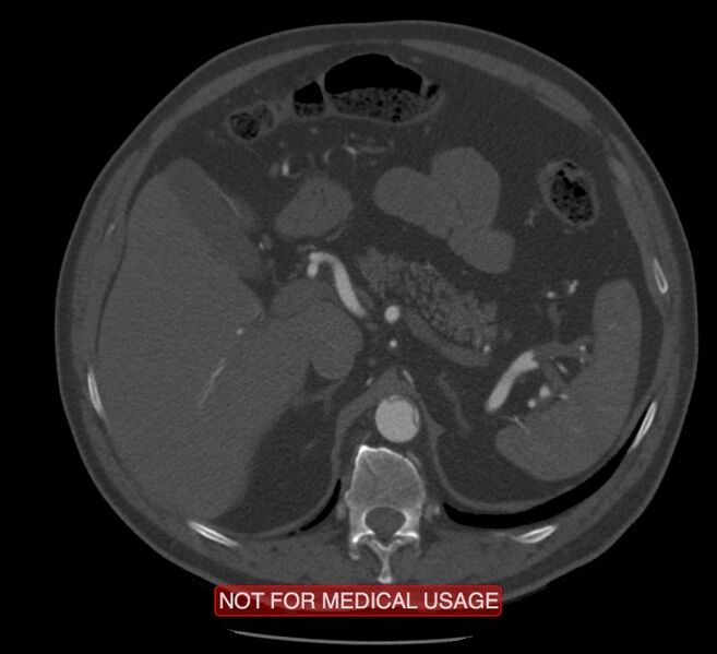 File:Acute aortic dissection - Stanford type A (Radiopaedia 40661-43285 Axial C+ arterial phase 86).jpg