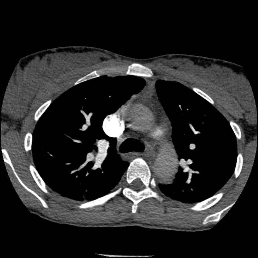 Acute chest syndrome - sickle cell disease (Radiopaedia 42375-45499 Axial C+ CTPA 64).jpg