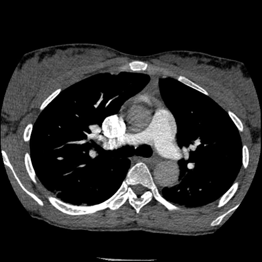 Acute chest syndrome - sickle cell disease (Radiopaedia 42375-45499 Axial C+ CTPA 70).jpg