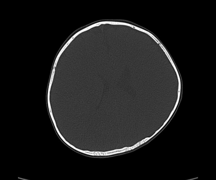 File:Acute hemorrhagic contusion (Radiopaedia 63660-72336 Axial bone window 43).jpg