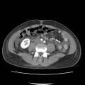 Acute myocarditis (Radiopaedia 55988-62613 Axial C+ portal venous phase 45).jpg