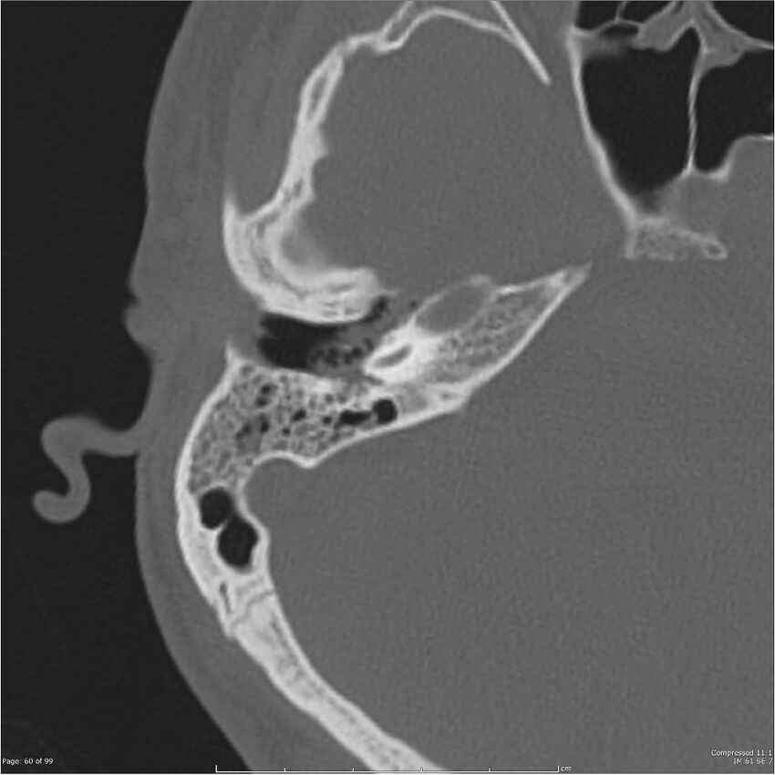 Acute otomastoiditis (Radiopaedia 28276-28512 Axial PTB bone window reformat 40).jpg