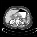 Acute pancreatitis (Radiopaedia 19136-19117 Axial C+ portal venous phase 11).jpg