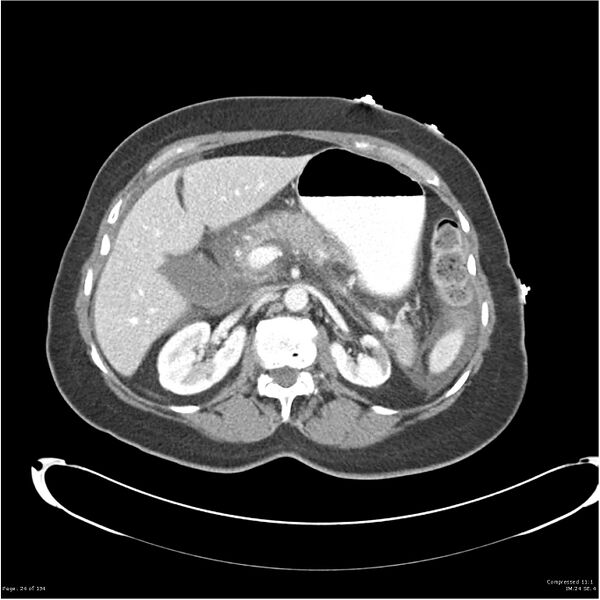 File:Acute pancreatitis (Radiopaedia 19136-19117 Axial C+ portal venous phase 11).jpg