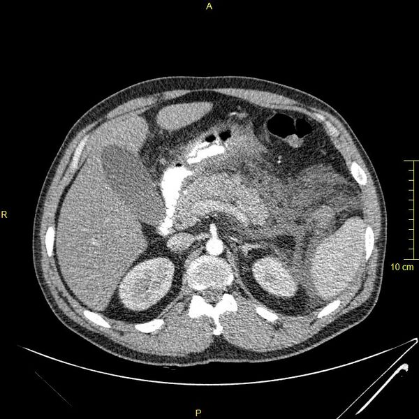 File:Acute pancreatitis (Radiopaedia 23231-23290 Axial C+ arterial phase 39).JPG