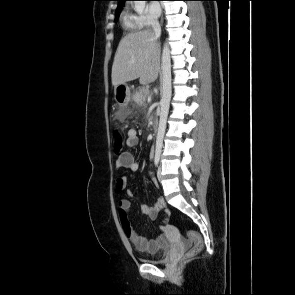 File:Acute pancreatitis (Radiopaedia 69236-79012 Sagittal C+ portal venous phase 52).jpg