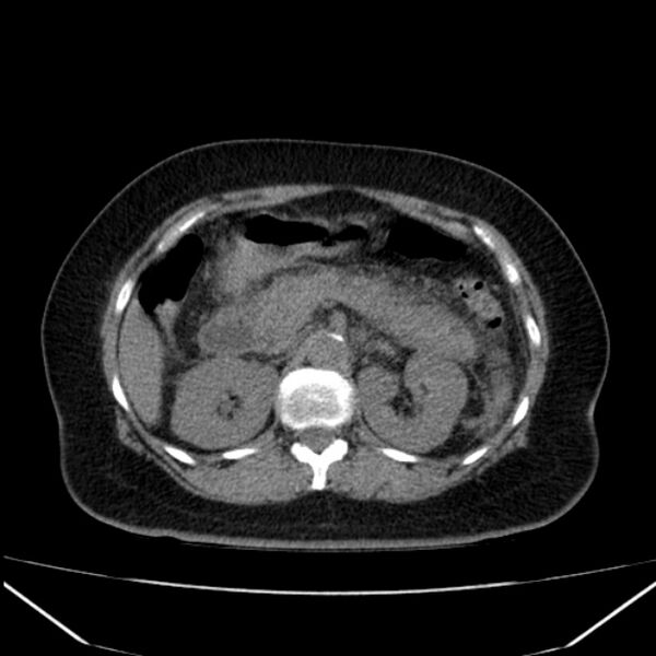 File:Acute pancreatitis - Balthazar C (Radiopaedia 26569-26714 Axial non-contrast 35).jpg