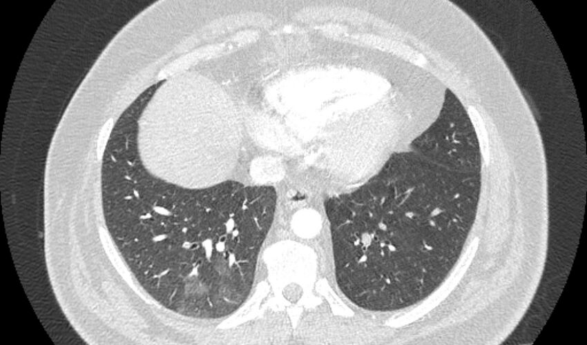 Acute pulmonary embolism with pulmonary infarcts (Radiopaedia 77688-89908 Axial lung window 94).jpg