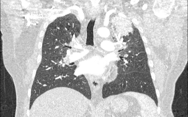 File:Acute pulmonary embolism with pulmonary infarcts (Radiopaedia 77688-89908 Coronal lung window 52).jpg