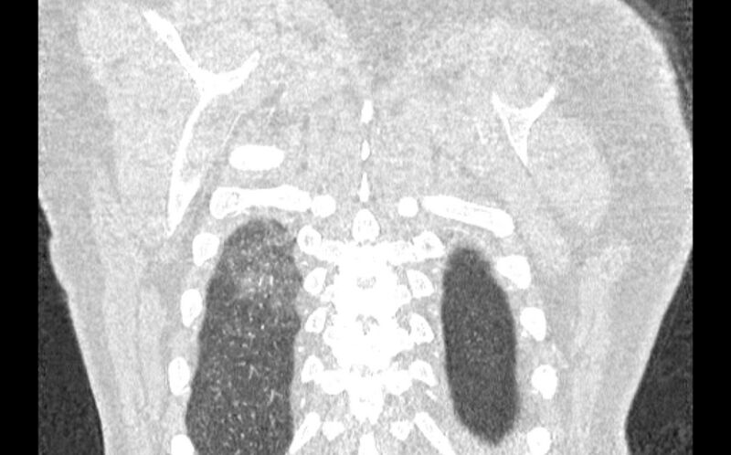 File:Acute pulmonary embolism with pulmonary infarcts (Radiopaedia 77688-89908 Coronal lung window 98).jpg