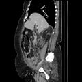 Acute pyelonephritis (Radiopaedia 25657-25837 Sagittal renal parenchymal phase 32).jpg