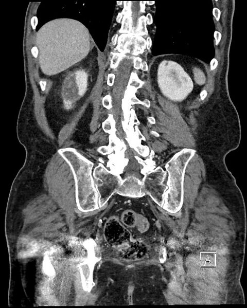 File:Acute renal infarction - rim capsular enhancement (Radiopaedia 59833-67270 Coronal C+ portal venous phase 49).jpg