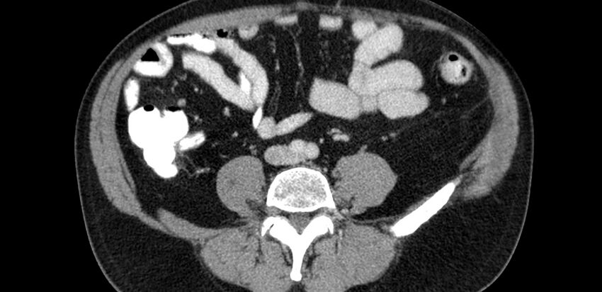 Acute sigmoid colon diverticulitis (Radiopaedia 55507-61976 Axial C+ portal venous phase 46).jpg