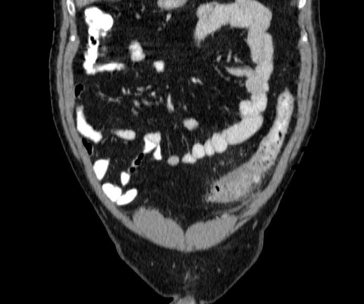 File:Acute sigmoid colon diverticulitis (Radiopaedia 55507-61976 Coronal C+ portal venous phase 27).jpg