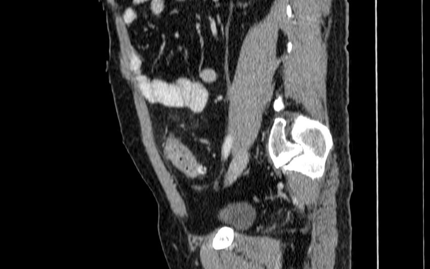 Acute sigmoid colon diverticulitis (Radiopaedia 55507-61976 Sagittal C+ portal venous phase 49).jpg