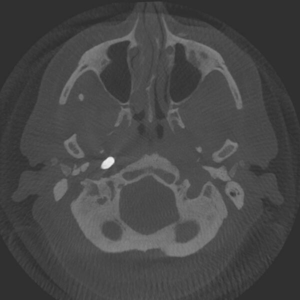 File:Acute subarachnoid hemorrhage and accessory anterior cerebral artery (Radiopaedia 69231-79010 Axial arterial - MIP 6).jpg