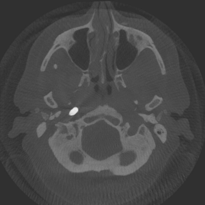 Acute subarachnoid hemorrhage and accessory anterior cerebral artery (Radiopaedia 69231-79010 Axial arterial - MIP 6).jpg
