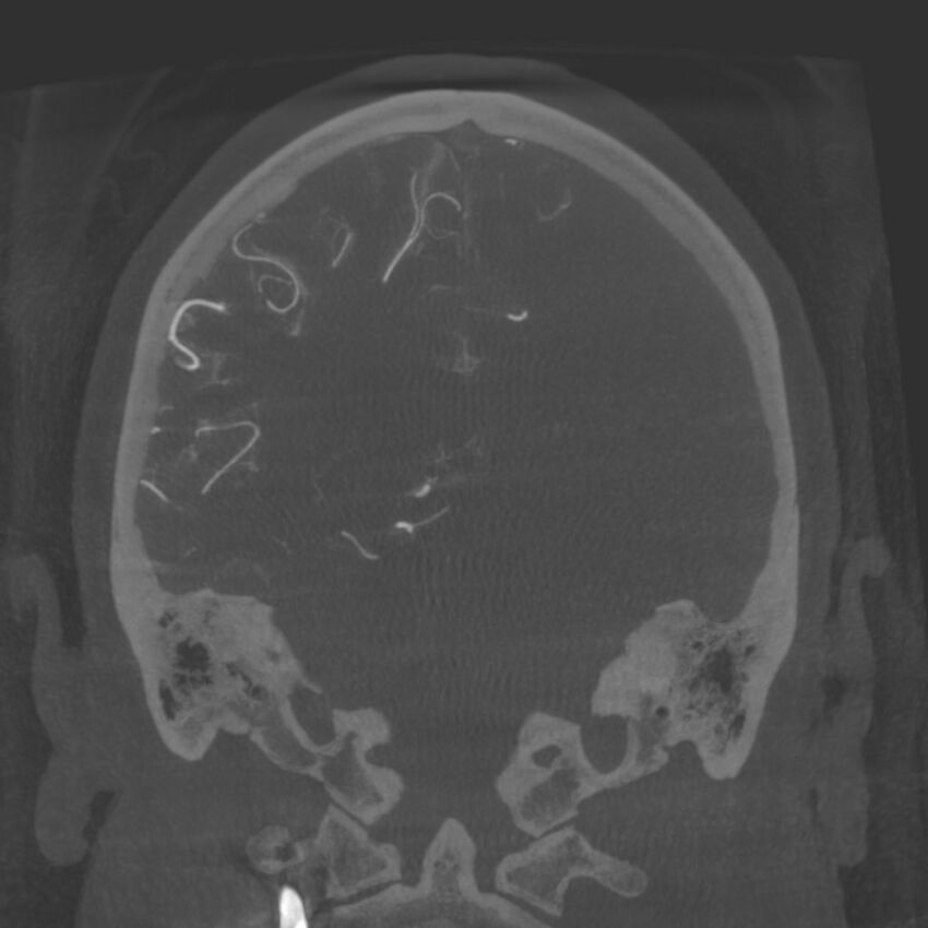 Acute subarachnoid hemorrhage and accessory anterior cerebral artery (Radiopaedia 69231-79010 Coronal arterial - MIP 69).jpg