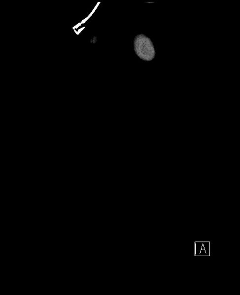 File:Acute uncomplicated appendicitis (Radiopaedia 61374-69304 Coronal C+ portal venous phase 2).jpg