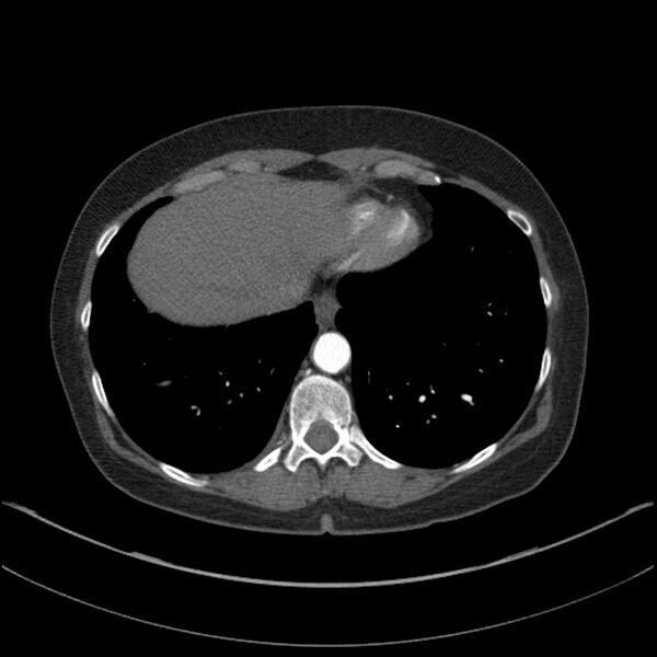 File:Adenocarcinoma of the lung (Radiopaedia 44205-47803 Axial C+ portal venous phase 68).jpg