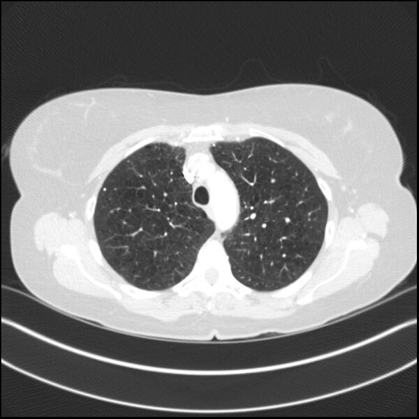 File:Adenocarcinoma of the lung (Radiopaedia 44205-47803 Axial lung window 28).jpg