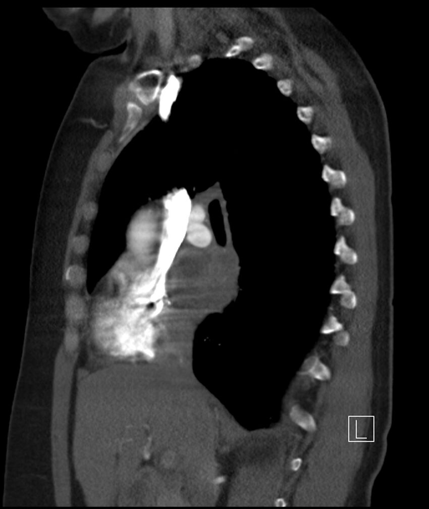 Adenocarcinoma of the lung (Radiopaedia 44205-47803 Sagittal C+ portal venous phase 33).jpg