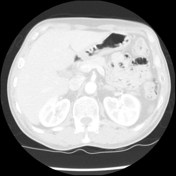 File:Adenocarcinoma of the lung - micropapillary predominant (Radiopaedia 42446-45563 Axial lung window 77).jpg