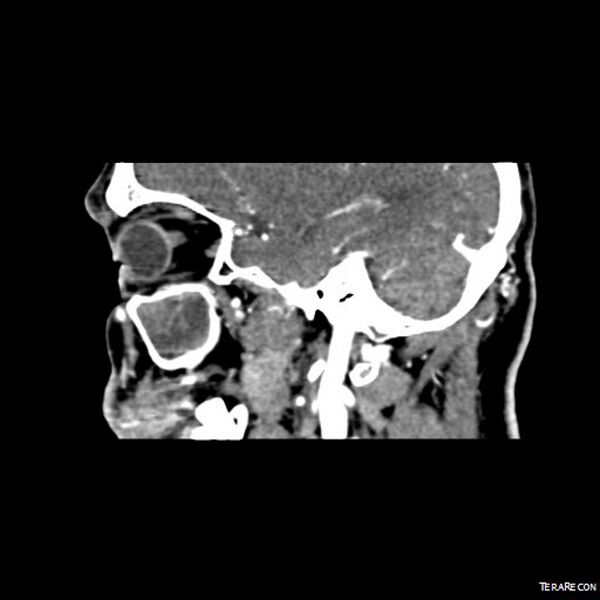 File:Adenoid cystic carcinoma involving paranasal sinus (Radiopaedia 16580-16283 Sagittal C+ arterial phase 11).jpeg