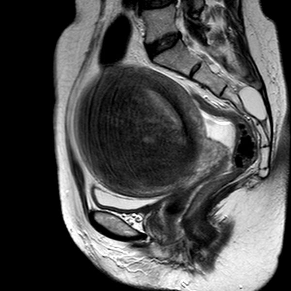File:Adenomyoma of the uterus (huge) (Radiopaedia 9870-10438 Sagittal T2 10).jpg