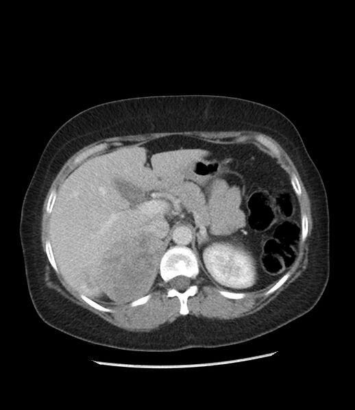 File:Adrenal cortical carcinoma with IVC invasion and thrombosis (Radiopaedia 34307-35597 Axial C+ portal venous phase 25).jpg
