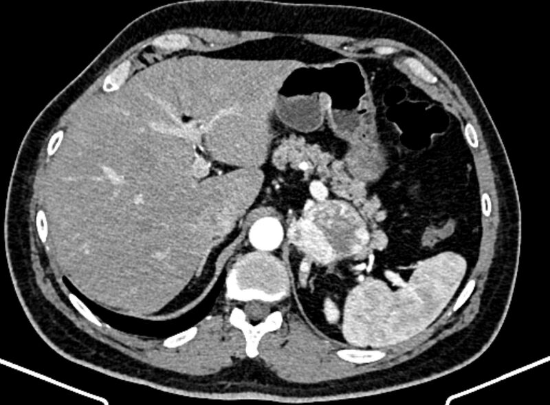 File:Adrenal metastases (Radiopaedia 73082-83791 Axial C+ arterial phase 39).jpg