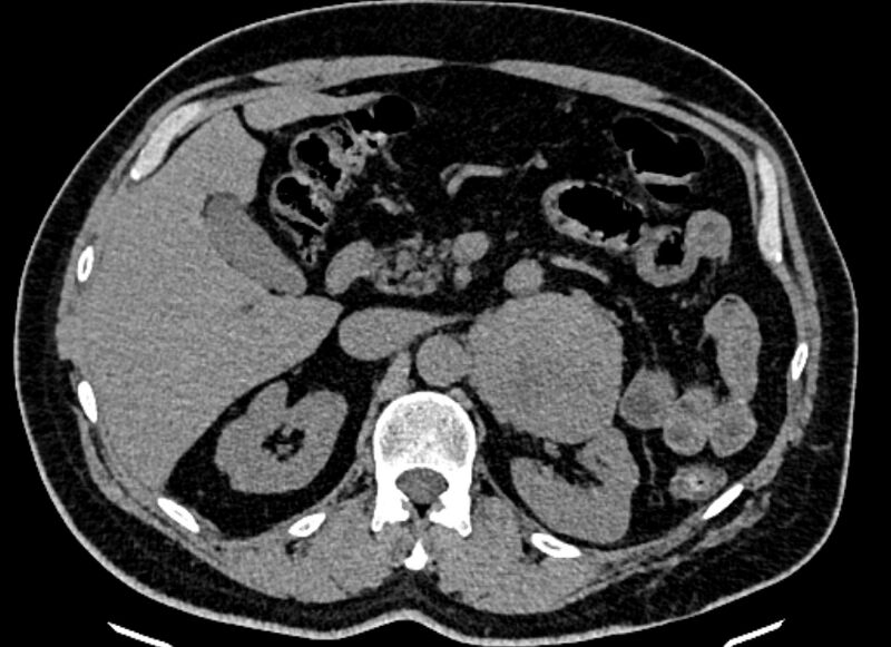 File:Adrenal metastases (Radiopaedia 73082-83791 Axial non-contrast 62).jpg