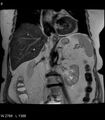Adrenal myelolipoma (Radiopaedia 6765-7961 Coronal T2 8).jpg