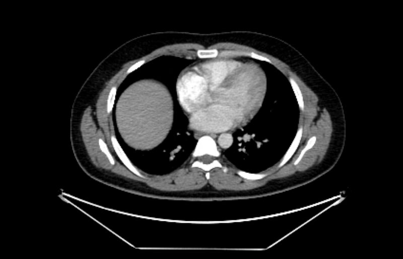 File:Adrenocortical carcinoma (Radiopaedia 80134-93438 Axial C+ portal venous phase 2).jpg
