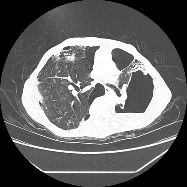 File:Advanced pulmonary tuberculosis (Radiopaedia 8599-9431 Axial lung window 25).jpg