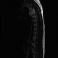 Aggressive vertebral hemangioma (Radiopaedia 39937-42404 Sagittal T2 3).png