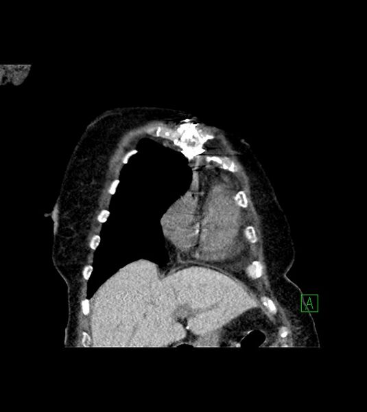File:Amiodarone deposition in the liver (Radiopaedia 77587-89780 Coronal non-contrast 19).jpg