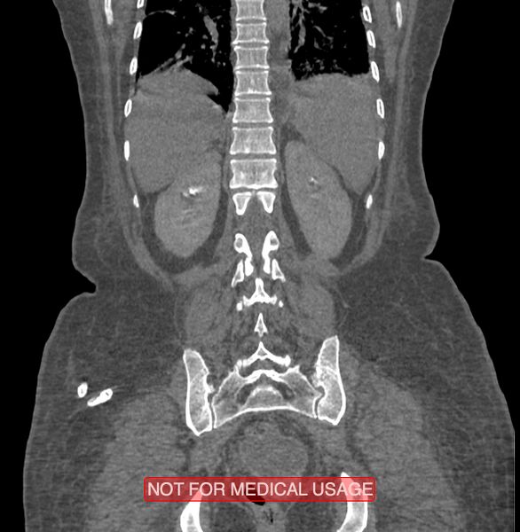 File:Amoebic enterocolitis with liver abscess (Radiopaedia 35100-36609 B 157).jpg