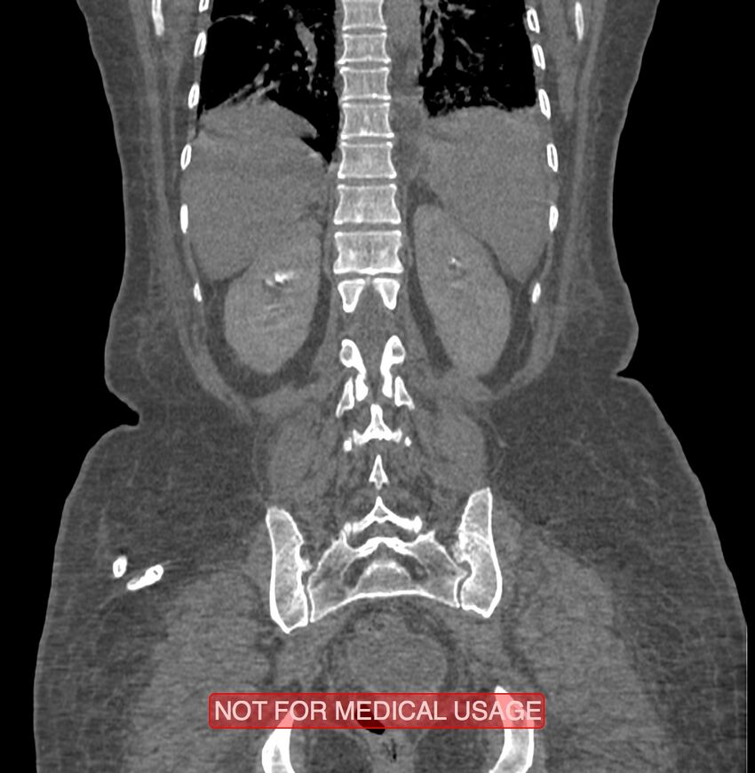 Amoebic enterocolitis with liver abscess (Radiopaedia 35100-36609 B 157).jpg