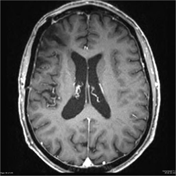File:Anaplastic meningioma with recurrence (Radiopaedia 34452-35788 Axial T1 C+ 86).jpg