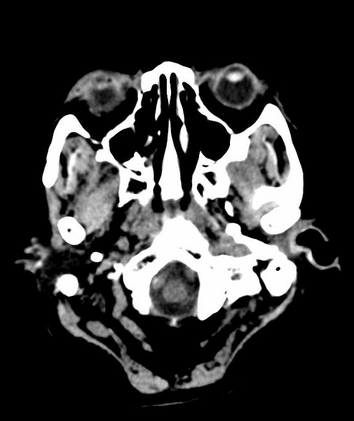 File:Anomalous intracranial venous drainage (Radiopaedia 28161-28418 Axial 61).png