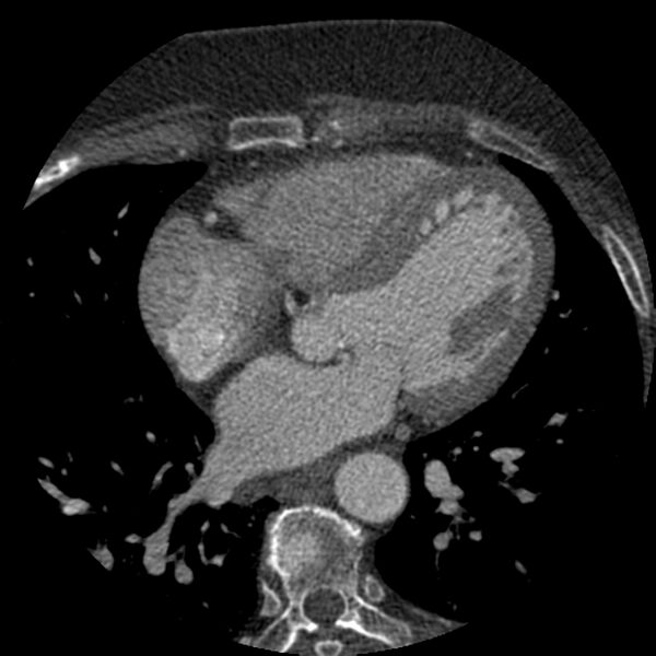 File:Anomalous origin of left circumflex artery from right coronary sinus (Radiopaedia 72563-83117 B 82).jpg