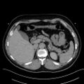 Anomalous origin of the left coronary artery with malignant course (Radiopaedia 77842-90126 Axial non-contrast 36).jpeg
