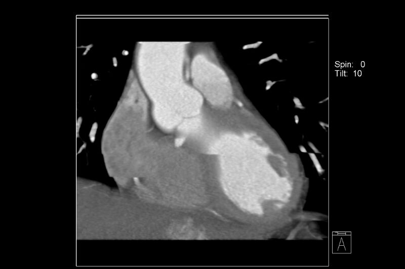 File:Anomalous right coronary artery (ARCA) with interarterial course (Radiopaedia 12423-12677 C 3).jpg