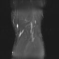 Anterior cruciate ligament full thickness tear (Radiopaedia 66268-75467 Coronal STIR 20).jpg