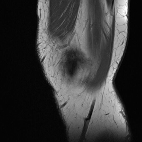 File:Anterior cruciate ligament tear - ramp lesion (Radiopaedia 71883-82322 Sagittal T1 24).jpg