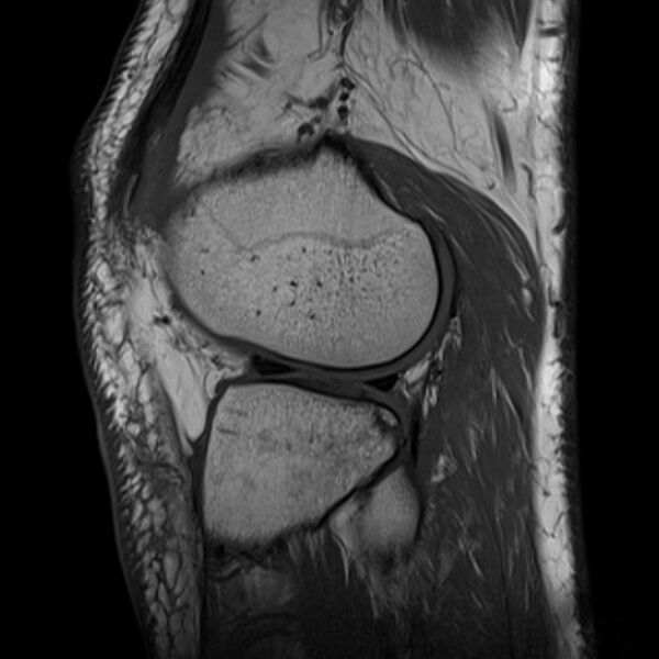 File:Anterior cruciate ligament tear - ramp lesion (Radiopaedia 71883-82322 Sagittal T1 7).jpg