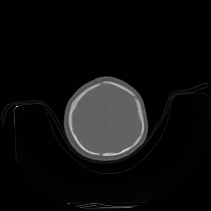 Anterior plagiocephaly (Radiopaedia 71836-82273 C 87).jpg