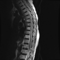 Anterior spinal artery syndrome (Radiopaedia 46335-50750 C 5).png