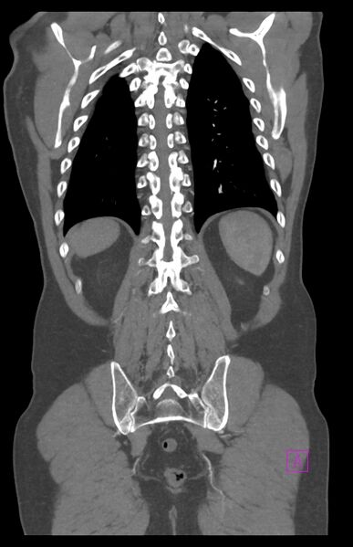 File:Aortectomy and axillary-bifemoral bypass (Radiopaedia 28303-28545 C 73).jpg